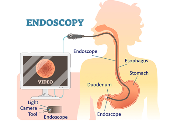 Endoscopic Procedure